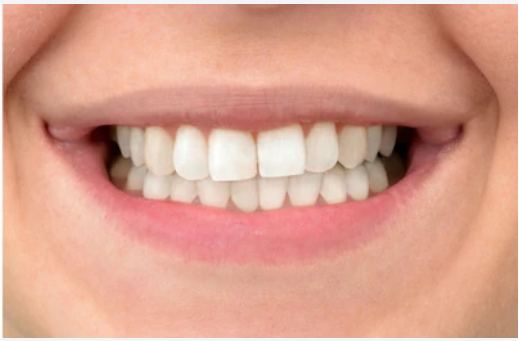 After – Teeth Cleaning