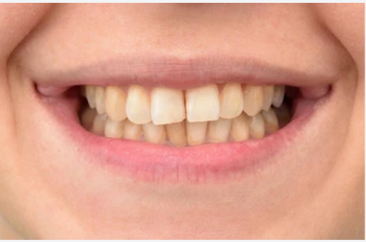 Before – Teeth Cleaning